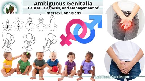 intersex gentiles|External Genitalia of an Intersex Individual